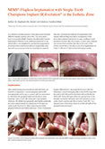 MIMI®-Flapless Implantation with Single-Tooth Champions® Implant (R)Evolution in the Esthetic Zone